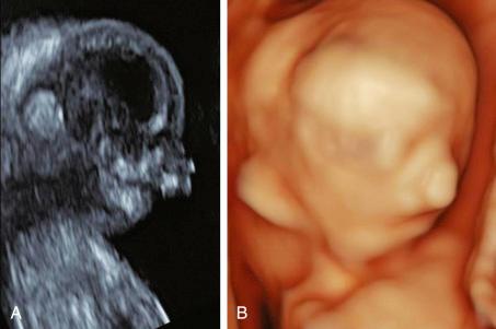 • Fig. 35.15, Two- and three-dimensional images of a first trimester fetus with bilateral clefts, premaxillary protrusion, maxillary gap and micrognathia. A, Sagittal 2D scan. B, 3D rendered image.