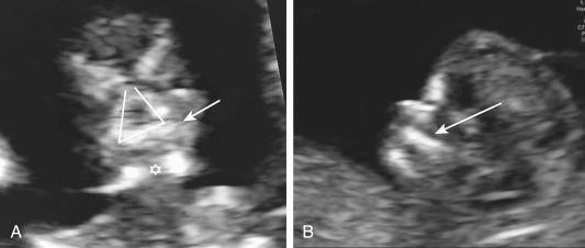 • Fig. 35.16, A, Coronal view (posterior to the nose) of a normal first trimester fetus, showing a normal retronasal triangle with intact palate (arrow) and a normal mandibular gap (asterisk) . The retronasal triangle is formed by three echogenic lines formed by the two frontal processes of the maxilla and the palate. B, Sagittal view of a normal first trimester fetus, showing an intact palate and no maxillary gap (arrow) .