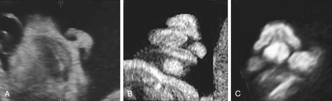 • Fig. 35.17, Two-dimensional image of frontal nose–mouth view showing an intact upper lip ( A ), a unilateral cleft lip ( B ) and a bilateral cleft lip ( C ).