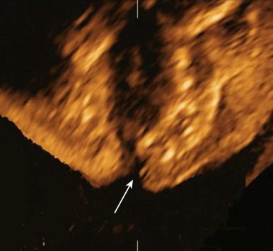 • Fig. 35.18, Two-dimensional image of axial plane through maxilla with unilateral cleft lip and palate. Arrow indicates the cleft.