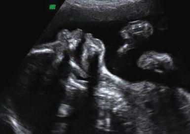 • Fig. 35.20, Two-dimensional ultrasound picture of a fetus with a backward-tilted head and open mouth, showing an intact hard and soft palate.