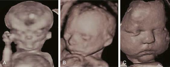 • Fig. 35.2, Three-dimensional rendered ultrasound images of a first ( A ), second ( B ) and third trimester ( C ) fetus.