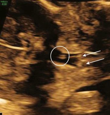 • Fig. 35.21, Coronal view through the pharynx showing the equal sign (circle) cranial to the vocal cords (arrows) .