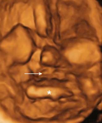 • Fig. 35.23, Three-dimensional ultrasound image of reversed-face view showing an intact palate (arrow) above the tongue (asterisk) .