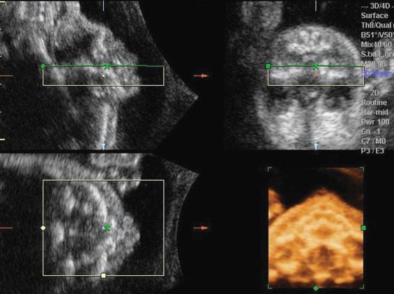 • Fig. 35.24, Three-dimensional multiplanar image with flipped-face technique of a fetus with an intact palate. The profile image in the left upper quadrant is turned upside down. The render box is adjusted to the size of the palate. In the box in the right lower quadrant , a rendered image of the palate is visible.