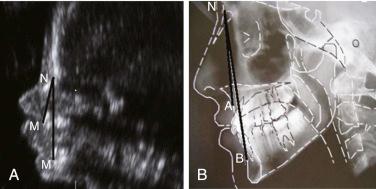 • Fig. 35.3, Prenatal two-dimensional ultrasound image of a fetus ( A ) with the maxilla–nasion–mandible angle ( MNM ) and postnatal cephalogram of a child ( B ) with point A–nasion–point B angle (ANB); the MNM angle is larger than the ANB angle, indicating a more convex profile in prenatal life.