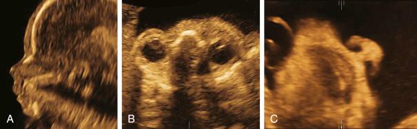 • Fig. 35.4, Ultrasound images showing the median profile view ( A ), the orbits in an axial view ( B ) and an anterior oblique coronal nose–mouth view ( C ).