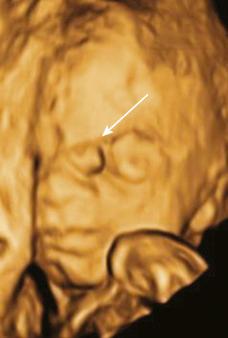 • Fig. 35.6, Three-dimensional surface-rendered image of fetus with nasofrontal encephalocele (arrow) .