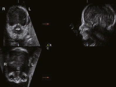 • Fig. 35.7, Example of multiplanar imaging with the fetal face turned in the standard position. R is the right side, and L is the left side of the fetus.