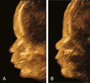 • Fig. 35.8, Ultrasound images of the fetal profile. A, A deviating midsagittal profile view, creating an image of retrognathia, flat nose and slightly bossing forehead. B, The exact midsagittal profile view obtained with multiplanar imaging of the same fetus, showing a normal profile.