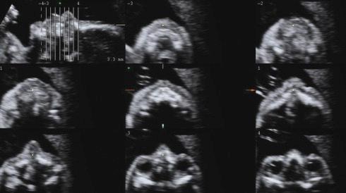 • Fig. 35.9, Example of tomographic ultrasound imaging display of the fetal face.