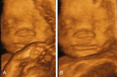 • Fig. 35.10, Three-dimensional rendered frontal view of the fetal face before ( A ) and after ( B ) use of the electronic scalpel to remove the hand in front of the face.