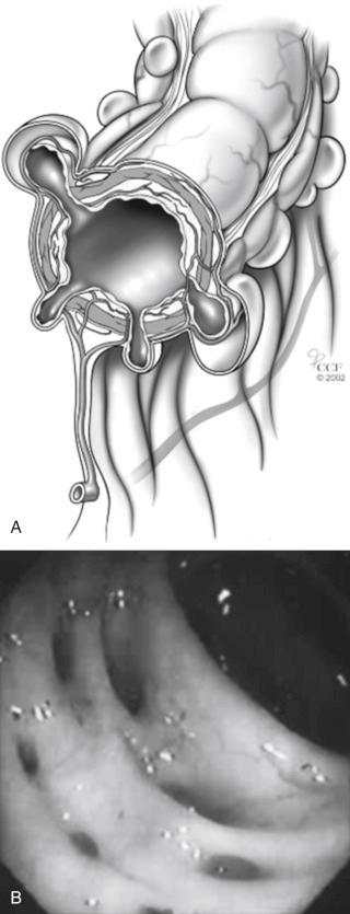 FIGURE 48-1, A, Colonic diverticulosis seen in cross-section shows mucosa/submucosa protruding through openings in the muscular bowel wall where vasa recta penetrate. B, Numerous diverticula seen on colonoscopy.