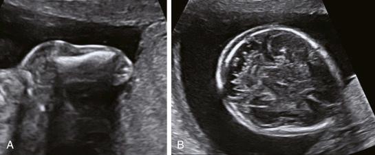 • Fig. 34.11, Sonographic findings in osteogenesis imperfecta type VIII. A, Short slightly bowed humerus. B, Slightly hypomineralised skull. Note how clearly the intracranial anatomy is visualised.