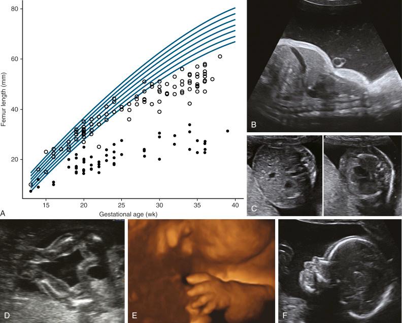 • Fig. 34.12, Sonographic findings in thanatophoric dysplasia. A, Chart of femur length showing the size of the femurs in thanatophoric (closed black dots ) dysplasia and achondroplasia (open black circles) plotted on centile charts for normal fetuses. B, Sagittal view of the thorax showing the typical ‘champagne cork’ appearance. C, Axial view showing the comparison between the thorax and abdominal circumferences. Note how short the ribs appear in this plane, finishing halfway around the thorax such that the heart has no protection from the ribs. D, View of the short legs in the typical ‘froglike’ position. E, The ‘trident hand’ viewed with three-dimensional ultrasound. F, Profile at around 22 weeks’ gestation showing marked frontal bossing.