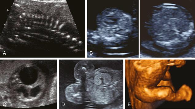 • Fig. 34.13, Sonographic findings in fetus with a short ribbed polydactyly syndromes (SRPS) at 16 weeks’ gestation. A, Longitudinal view through the thorax of a fetus with SPRS demonstrating the extremely short ribs. B, The thorax of a fetus with achondroplasia viewed in the axial plane with the heart appearing to lie virtually outside the thorax. Note the comparison with the abdominal size. C, Axial view through the abdomen in this fetus with SRPS and obstructive uropathy. D, Views of another fetus with SRPS and large echogenic kidneys. The very short femora are also visible. E, Three-dimensional view of a fetus with SRPS showing the short limbs and polydactyly of the feet.