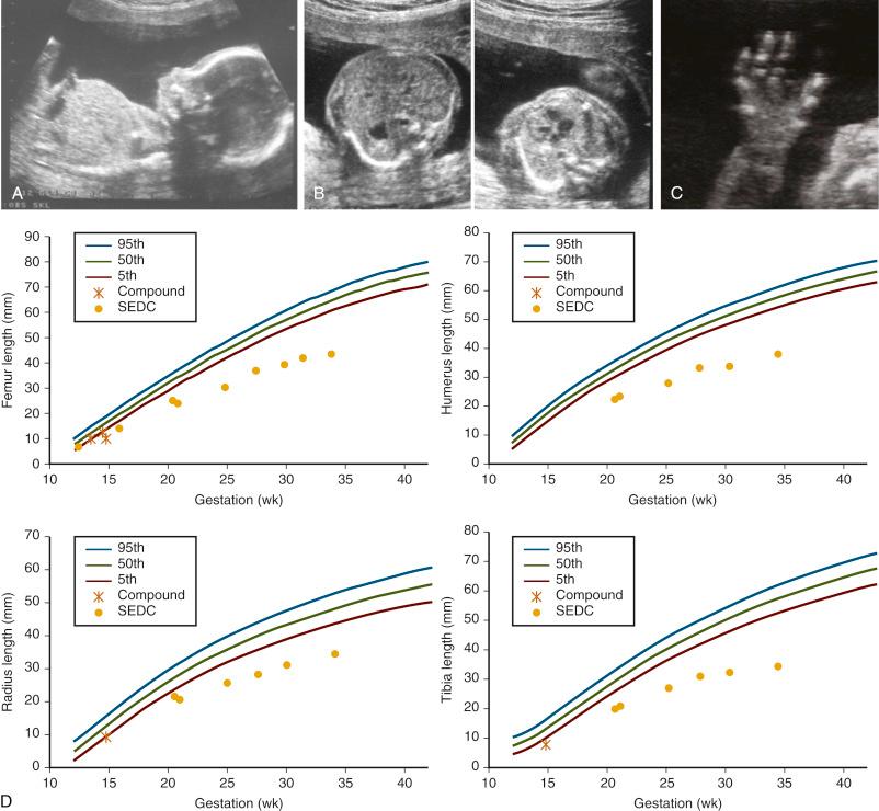 • Fig. 34.14, Sonographic findings in spondylo-epiphyseal dysplasia congenita (SEDC). A, Sagittal view of a fetus with SEDC at 18 weeks’ gestation, demonstrating micrognathia but no frontal bossing and a short thorax. B, Axial view through the chest and abdomen at 18 weeks’ gestation. Note that the chest appears slightly small, but the heart only occupies one third of the chest, and the ribs are of normal length. C, A hand in SEDC with normal length fingers compared with those seen in thanatophoric dysplasia at around the same gestation. D, Long bone growth in two fetuses with SEDC plotted on charts of normal size. Note the difference in size compared with measurements in thanatophoric dysplasia in Fig. 34.12A.