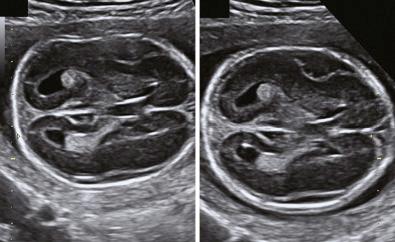 • Fig. 34.3, Anomalies of the fetal skull. Ultrasound images of a fetus with osteogenesis imperfecta type IIa showing profound hypomineralisation and lack of an acoustic shadow, resulting in very clear visualisation of the intracranial anatomy.