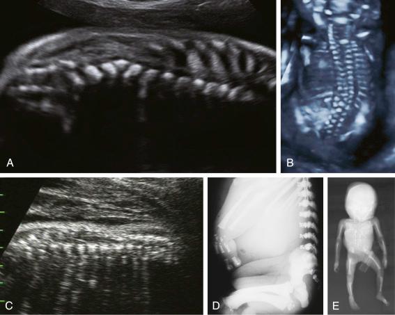 • Fig. 34.4, Spinal anomalies. A, Coronal view of a fetal spine showing multiple hemivertebrae. B, Three-dimensional image of hemivertebrae. C, Coronal view of a spine in a fetus with brachytelephalangic chondrodysplasia punctata. D, Radiograph showing lateral view of the spine in this neonate with brachytelephalangic chondrodysplasia punctata. E, Radiograph of a fetus with Jarcho-Levin syndrome.