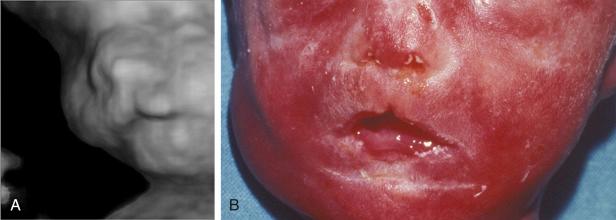 • Fig. 34.5, Small midline cleft lip as may be found in Majewski, oral facial digital (OFD) syndrome type IV or Ellis-van Creveld syndrome. A, Three-dimensional ultrasound image of the same fetus. B, Coronal view after birth.