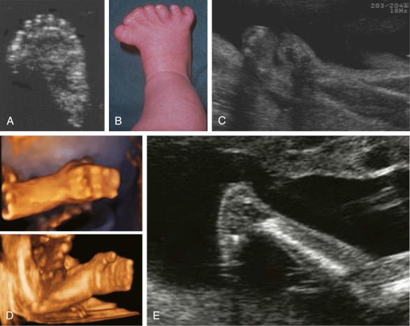 • Fig. 34.6, Clues to the diagnosis that may be found in the hands and feet. A, Ultrasound image of preaxial polydactyly of the feet in Greig acrocephalopolysyndactyly. B, The view of this foot after birth. C, Ultrasound image showing the syndactyly resulting in the mitten hand seen in Apert syndrome. D, The same hand as in C but visualised using three-dimensional ultrasound. E, Rocker bottom foot.