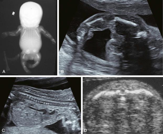 • Fig. 34.7, Sonographic findings in achondrogenesis. A, Radiograph of a fetus with achondrogenesis type II. B, Very short, straight leg bones, showing mesomelic shortening. C, Coronal view of the spine showing the ‘tram-line appearance’ caused by hypomineralisation of vertebral bodies. D, Transverse section through the lower thorax showing very short ribs.