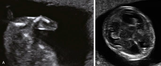 • Fig. 34.8, Sonographic findings in hypophosphatasia. A, Image of an acutely angulated femur in a fetus with hypophosphatasia at 14 weeks’ gestation. B, Image of the same fetus at 14 weeks’ gestation showing the hypomineralisation of the skull.