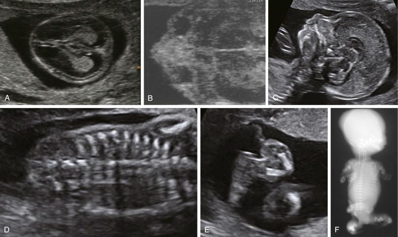 • Fig. 34.9, Sonographic findings in the osteogenesis imperfecta types IIA and IIC. A, Hypomineralised skull. Note the lack of acoustic shadow and clarity of intracranial contents. B, Hypomineralised facial bones. C, Hypomineralisation is also clearly seen in the sagittal view of the head, which also shows the relatively flat profile. D, Short, beaded ribs. E, Bent distal leg. Note the relatively normal length foot with absent mineralisation. F, Radiograph of a fetus with osteogenesis imperfecta type IIC.