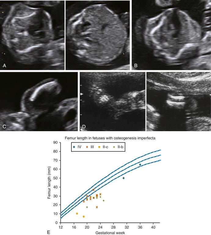 • Fig. 34.10, Sonographic findings in osteogenesis imperfecta (OI) type IIB. A, Axial view comparing the size of the thorax and abdomen demonstrating the slightly small chest. B, Axial view through the thorax shows flaring of the ends of the ribs. C, The femur is short and angulated. D, The tibia and fibula are short, but foot length is preserved. E, Fetal femur size chart showing the normal range with measurements from fetuses with OI IIA, IIB, III and IV plotted.