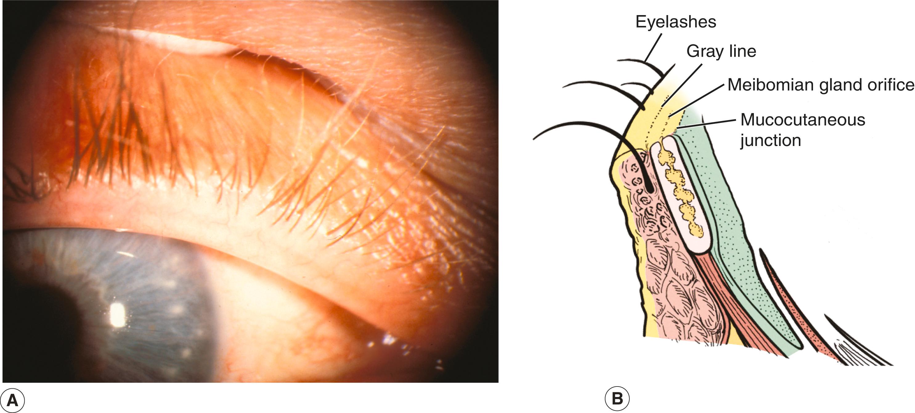 Figure 5.1, Normal eyelid margin. ( A ) The lid margin is a flat platform with a sharp right-angled posterior edge. ( B ) Normal landmarks (from posterior to anterior) are the mucocutaneous junction, meibomian gland orifices, gray line, and eyelashes.