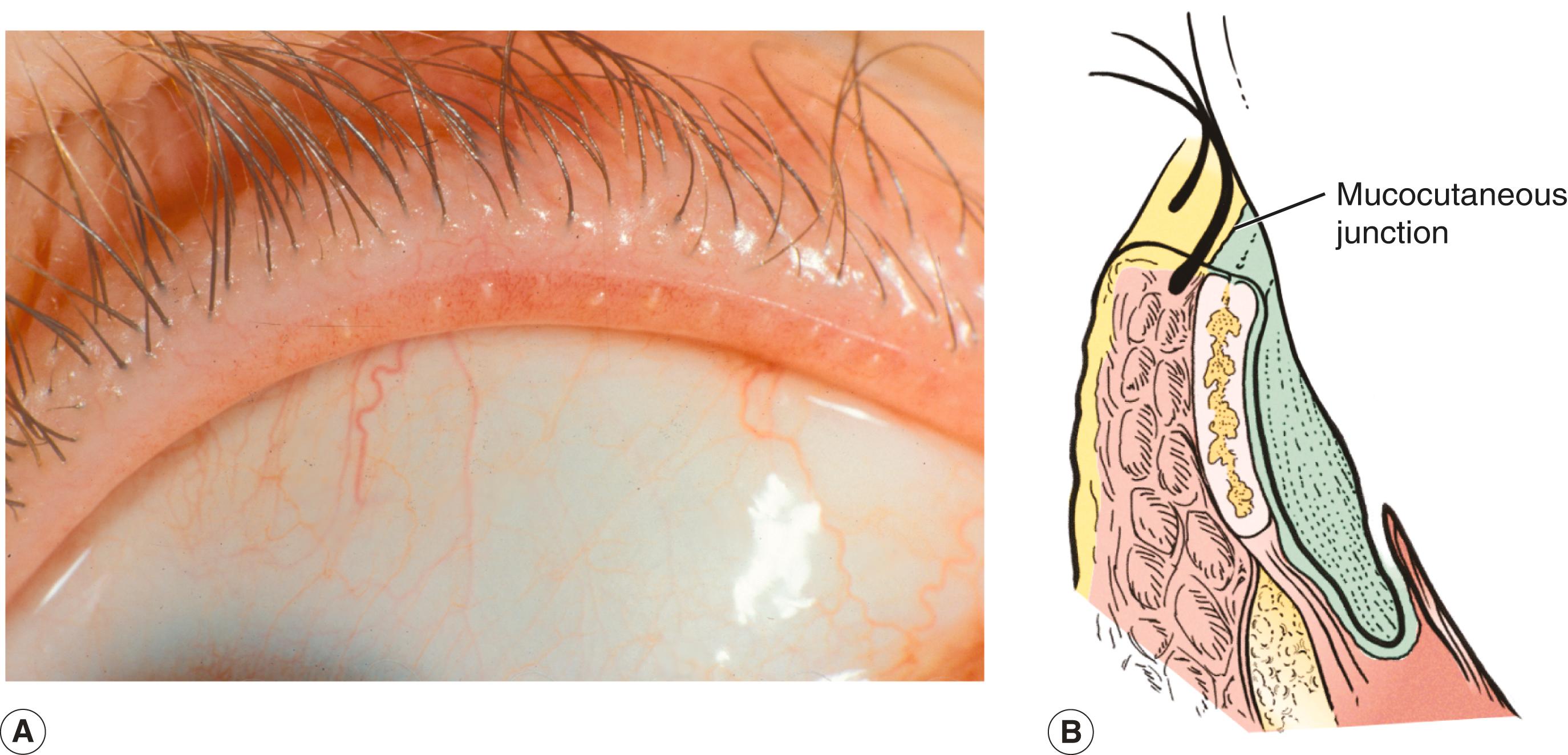 Figure 5.2, Marginal entropion. ( A and B ) Mild posterior lamellar shortening causes rounding of the lid margin and anterior migration of the mucocutaneous junction.