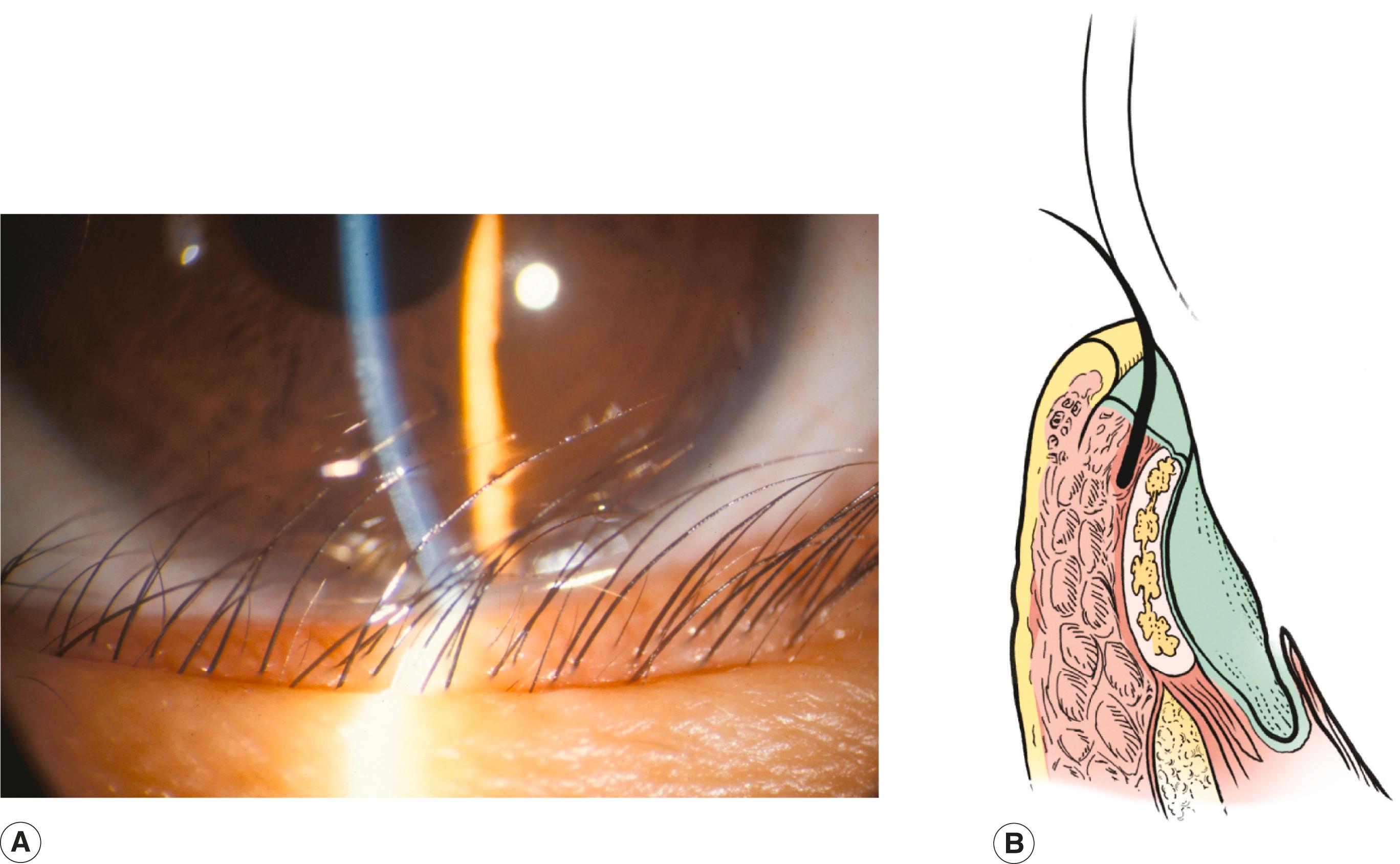 Figure 5.4, Epiblepharon. ( A and B ) A redundant roll of skin pushes the eyelashes upward against the cornea in a parallel orientation.