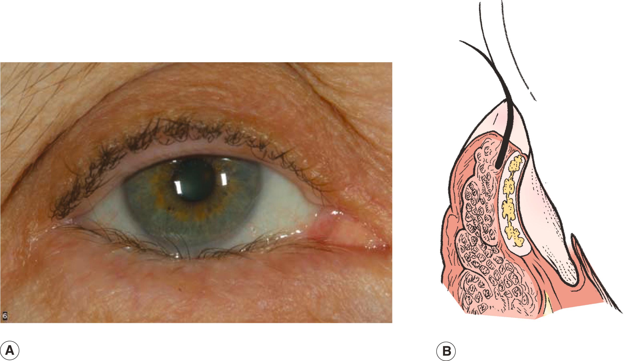 Figure 5.6, Involutional entropion for comparison. The lid margin is turned inward, indicating entropion rather than trichiasis. Laxity of the lower eyelid retractors, horizontal eyelid laxity, and an overriding preseptal orbicularis muscle are etiologic factors. In most cases, the entropion is intermittent and the mucocutaneous margin may not migrate anteriorly.