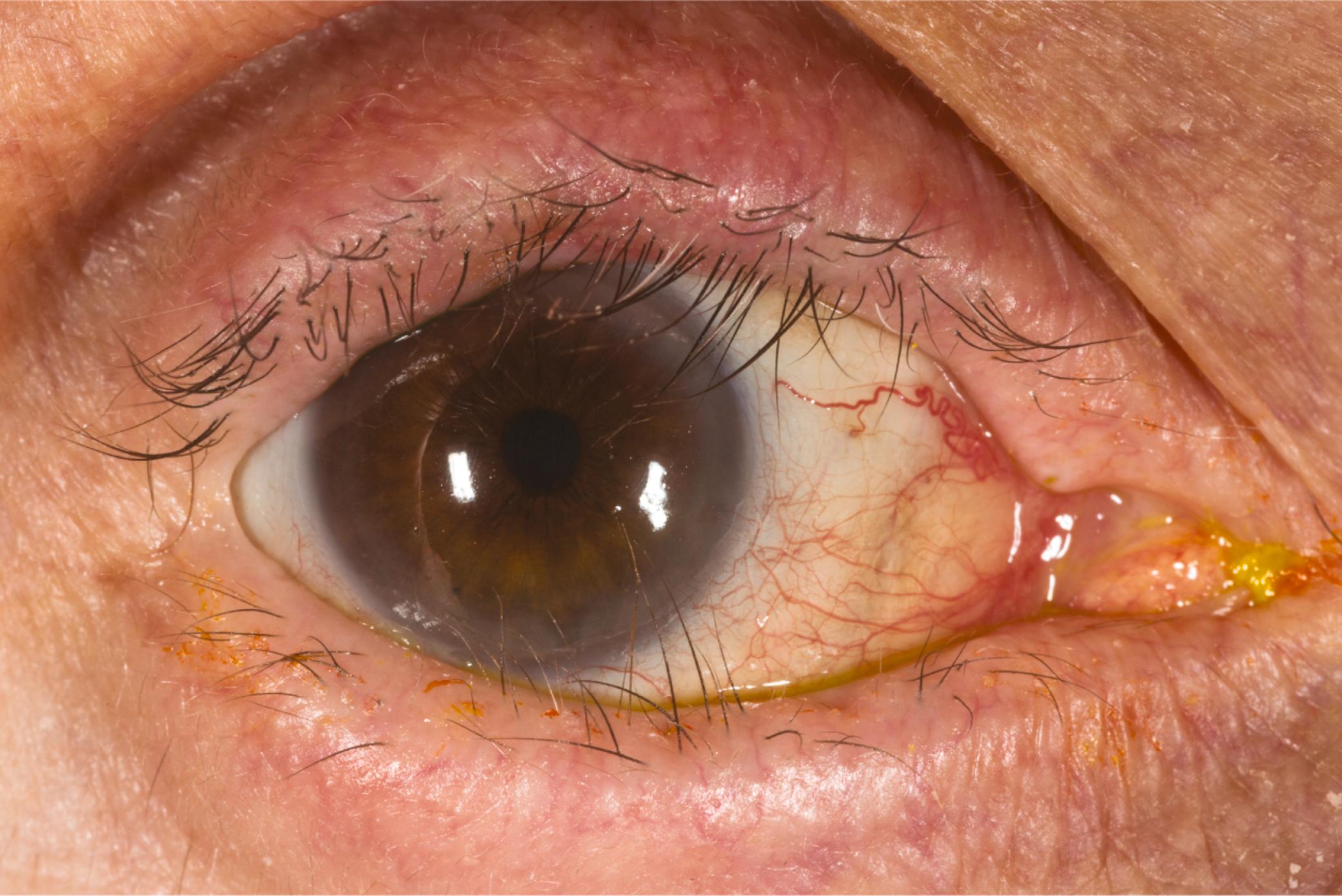 Figure 5.7, The eyelashes are misdirected against the eye. The eyelids appear to be rolled inward somewhat. No focal scarring of the posterior lamella was present. Is this a case of trichiasis or entropion? This example illustrates the importance of the concept of posterior lamellar shortening in understanding both cicatricial entropion and the trichiasis of marginal entropion.
