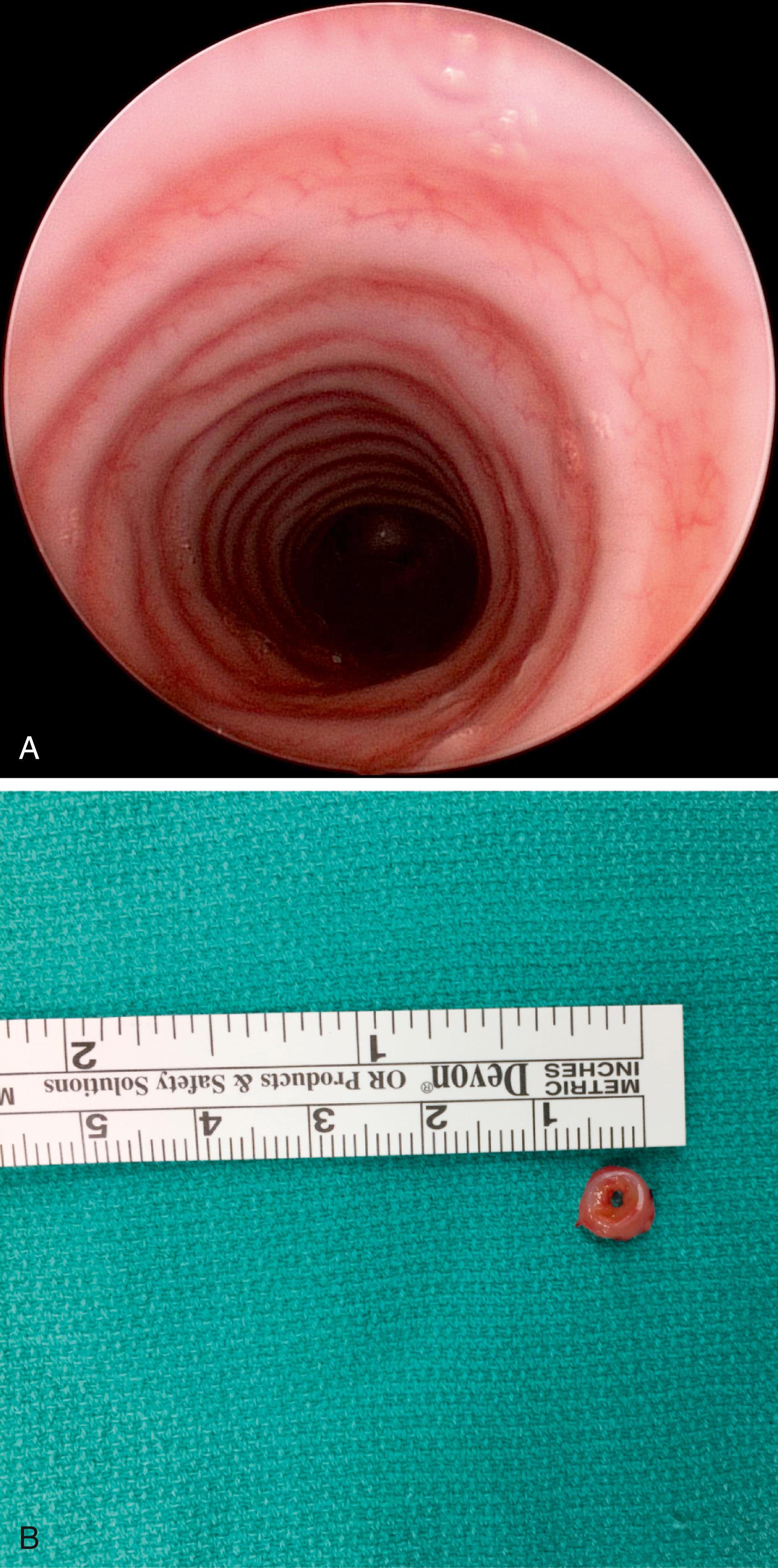 Fig. 30.1, (A) Long-segment tracheal stenosis (complete rings), endoscopic view. (B) Tracheal stenosis (complete ring), gross anatomic view of a resected ring.