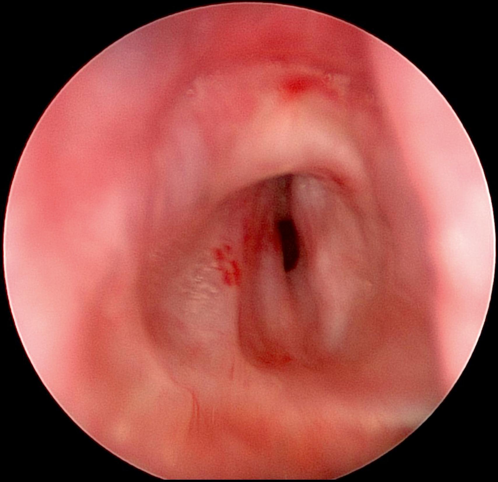 Fig. 30.2, Short-segment tracheal stenosis.