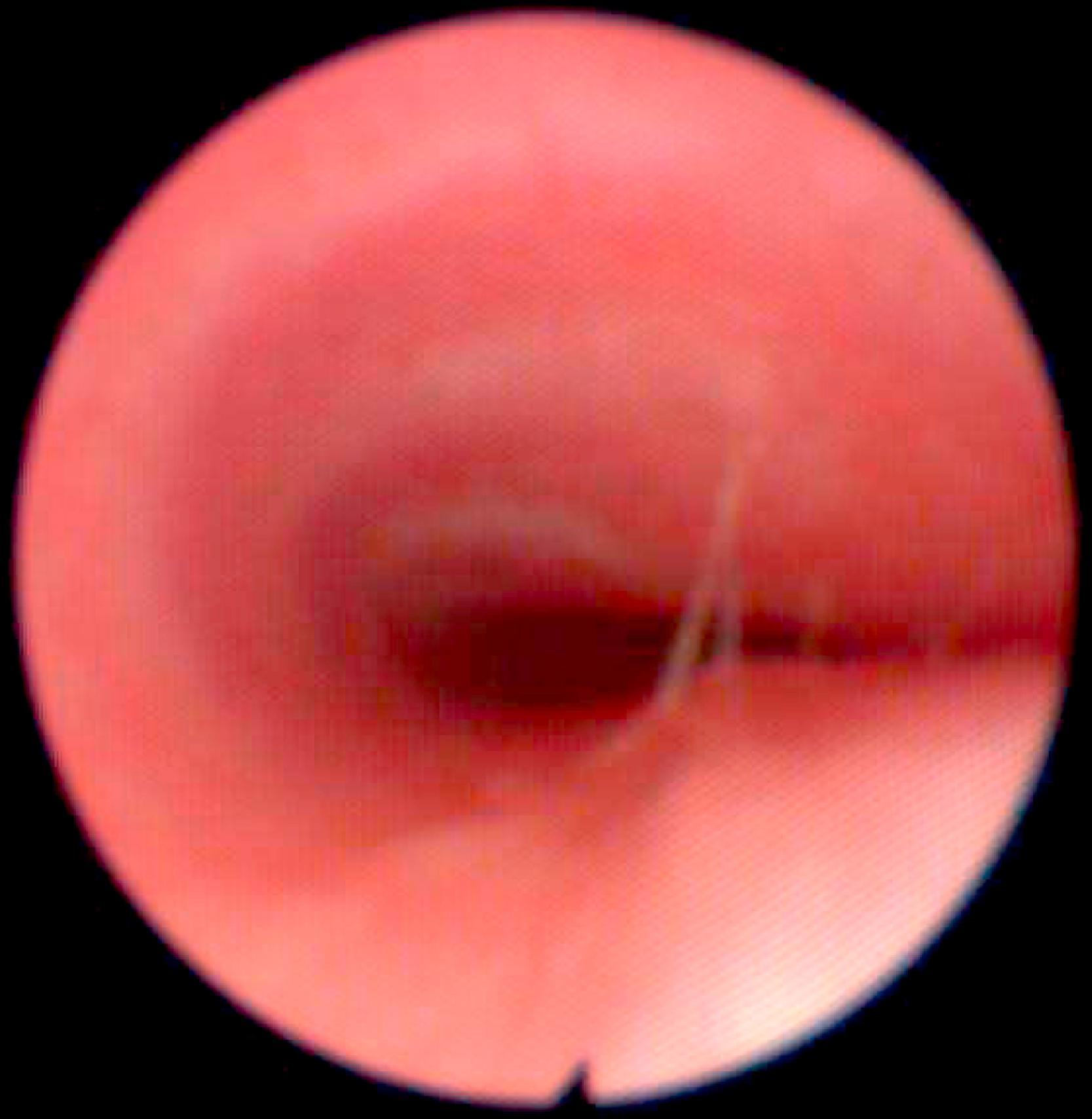 Fig. 30.3, Tracheomalacia.