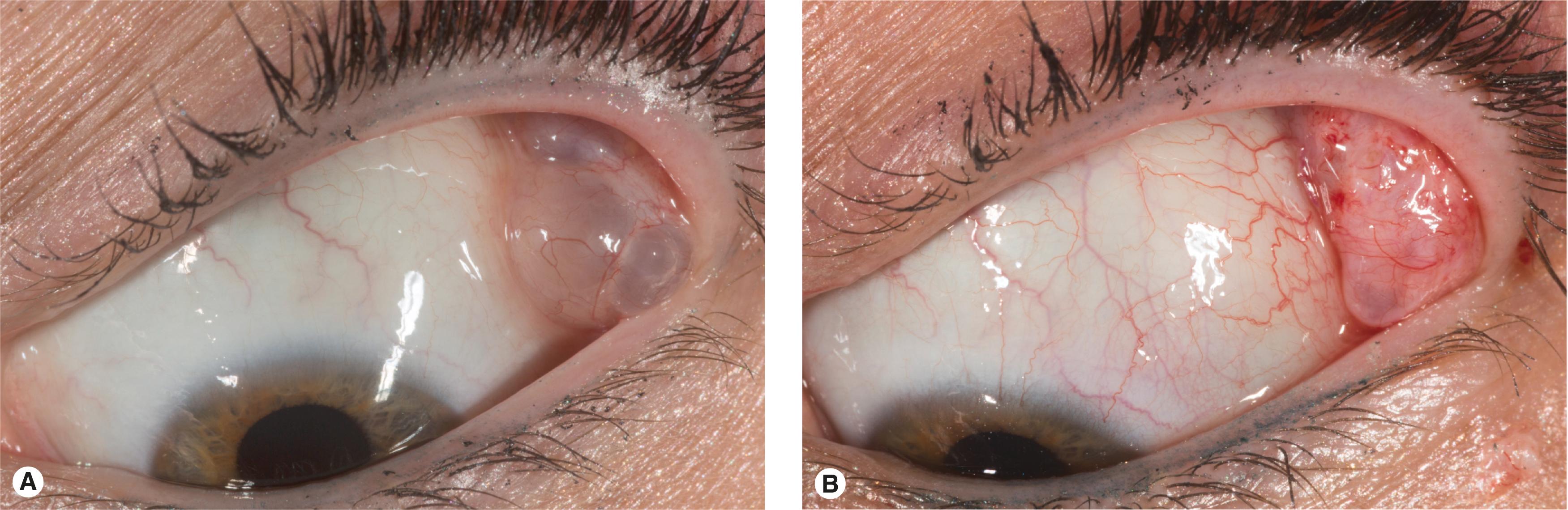 Figure 10.1, Dacryops. Have you ever wondered where the lacrimal gland ductules are? ( A ) When you see a case of dacryops, you have a clear understanding. Dacryops form when the opening of one or more ductules is occluded. The result is a cystic swelling of the ductule filled with aqueous tears. ( B ) Multiple dacryops have been marsupialized. In a normal patient, you cannot see the ductule openings, but they are found overlying the palpebral lobe of the lacrimal gland. A fluorescein Seidel test over the gland viewed with the blue light on the slit lamp or microscope sometimes shows you the dozen or so openings. It may be worth trying.