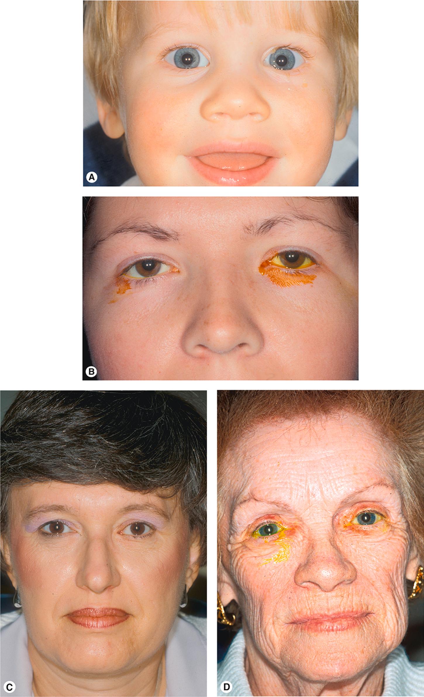 Figure 10.3, The diagnosis of tearing by age. ( A ) A child with congenital NLD obstruction. ( B ) A young adult with canalicular obstruction caused by viral conjunctivitis (the other cause in this age group is trauma). ( C ) A middle-aged woman with recurrent tearing resulting from a dacryolith. ( D ) An older adult with tearing caused by primary acquired NLD obstruction.