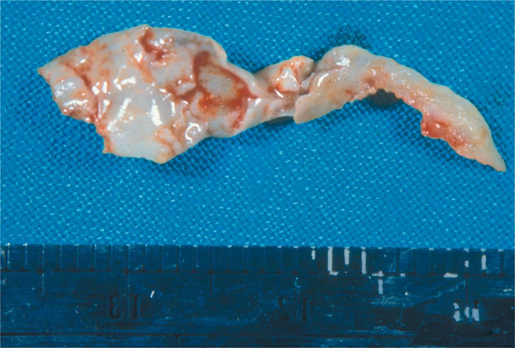 Figure 10.4, An unusually large dacryolith removed from the nasolacrimal sac and duct of a middle-aged woman (see Figure 10.2 ), showing a cast of the entire lacrimal excretory system.