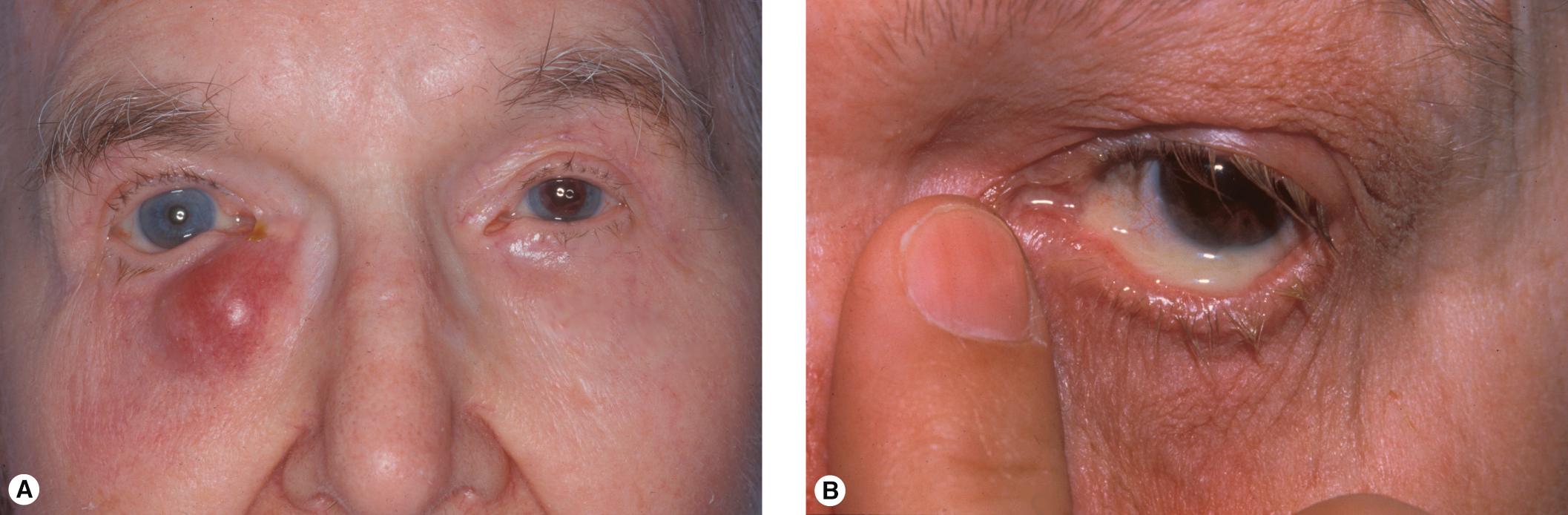 Figure 10.5, Dacryocystitis means an NLD obstruction is present. ( A ) Acute dacryocystitis. ( B ) Chronic dacryocystitis.