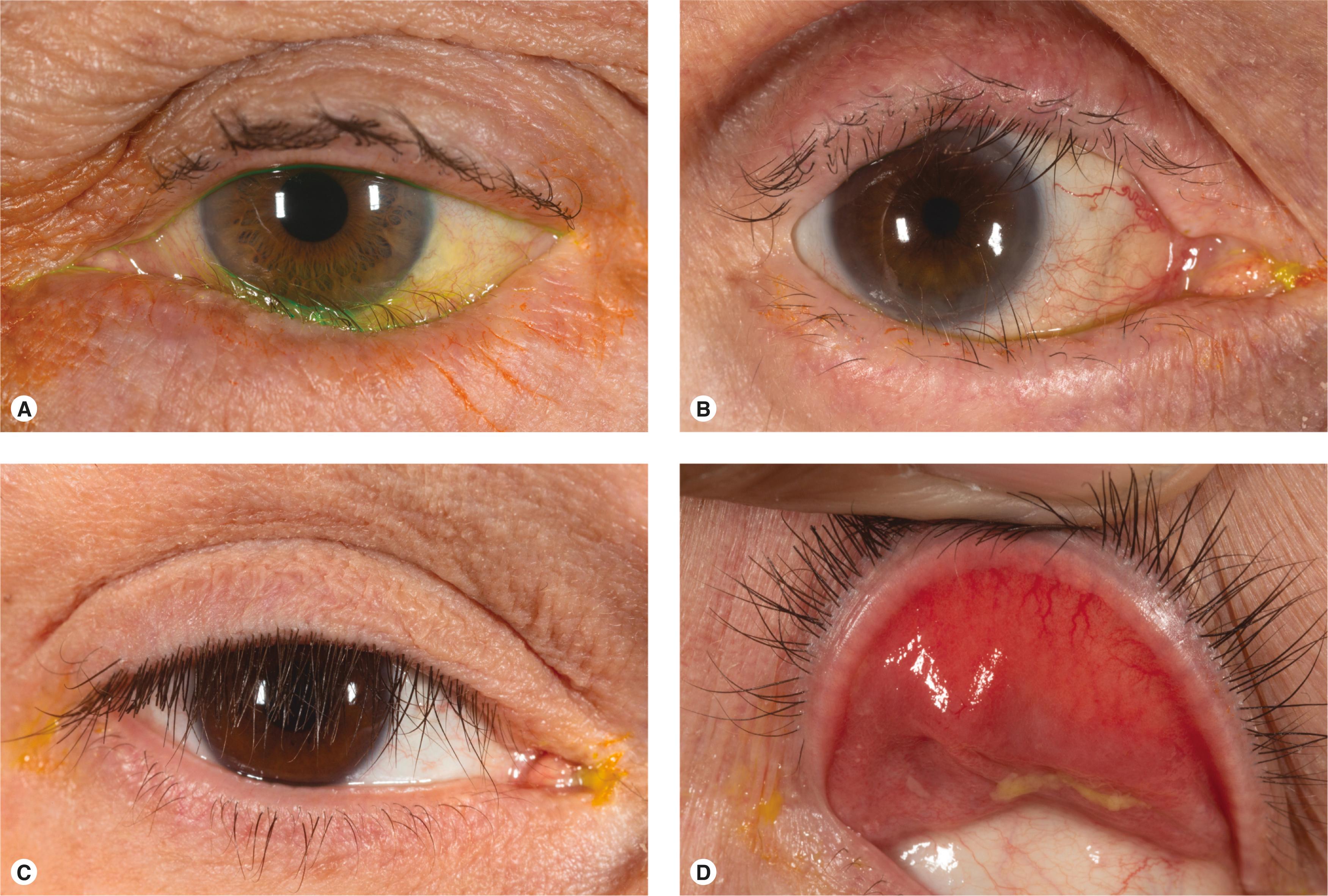 Figure 10.6, Entropion and ectropion. Rule out conditions related to the eyelids or eyelashes that may be a cause of reflux tearing or poor lacrimal pump function. It is best to treat these obvious causes before looking for an obstructive etiology. ( A ) Involutional entropion. ( B ) Cicatricial entropion. Both the lower and upper eyelashes are directed inward. ( C ) Eyelash ptosis seen in floppy eyelid syndrome. ( D ) Extreme upper eyelid laxity with erythematous conjunctiva and strands of mucus in floppy eyelid syndrome.