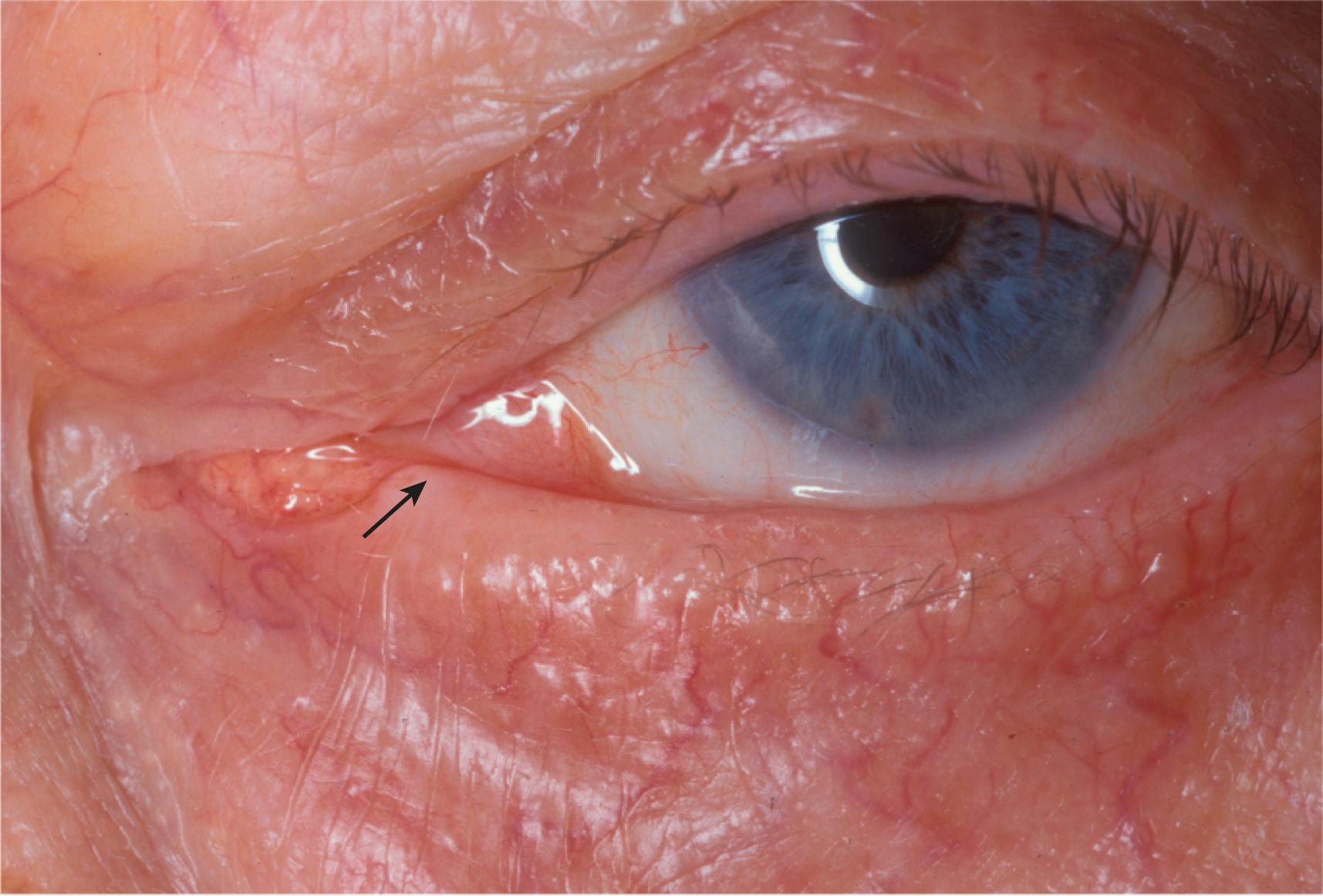 Figure 10.7, The normal punctum should be apposed to the globe. Punctal eversion ( arrow ) may be subtle and a cause of epiphora, especially in a young patient.