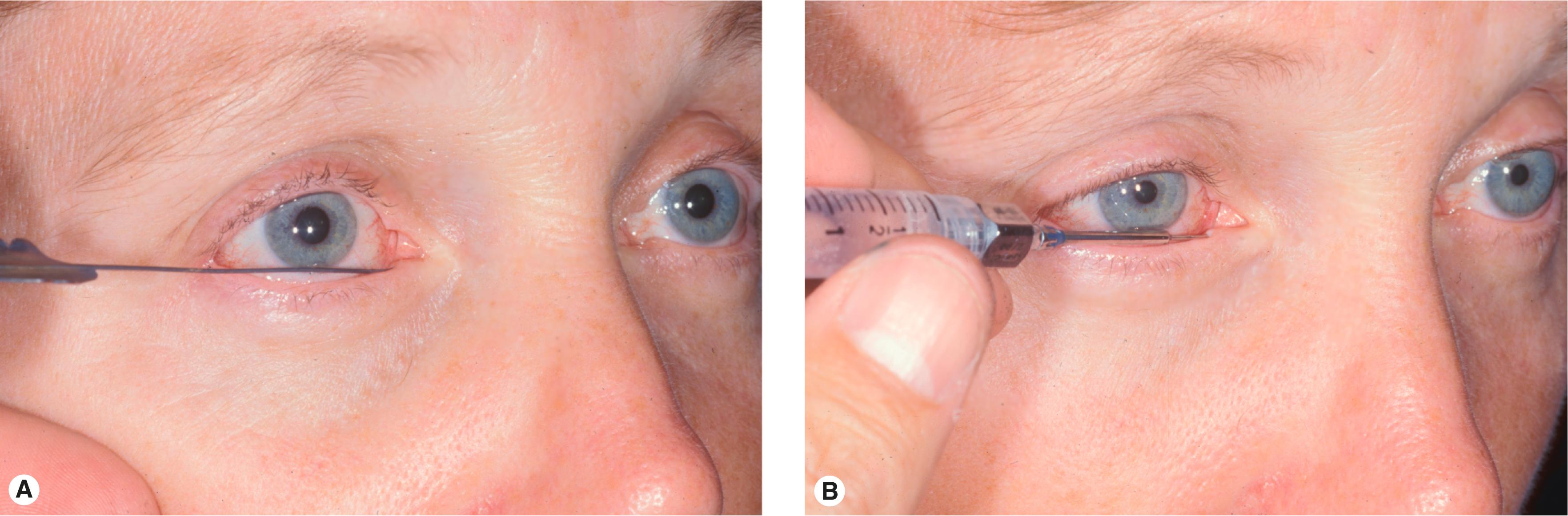 Figure 10.10, Lacrimal examination. ( A ) Canalicular palpation using a no. 0 or 00 Bowman probe (Storz E4200–E4205 for a complete set) to test patency of the canaliculus. ( B ) Lacrimal irrigation using a lacrimal cannula (Storz E4406 or E4404) to test patency of the NLD. No reflux through the opposite canaliculus should be present.