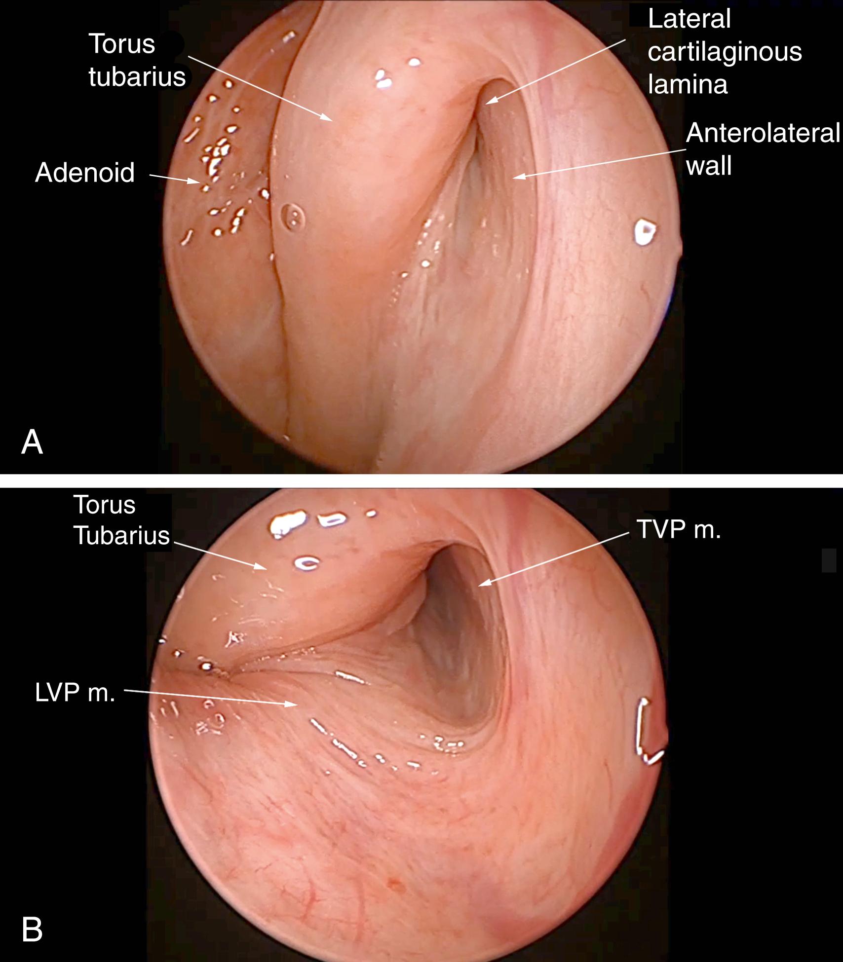 Fig. 6.1, Normal eustachian tube (left) in a 45-degree, 3-mm diameter endoscopic view. The patient is seated in the office. (A) Resting position: the functional valve is closed (the mucosal surfaces of the anterolateral wall and the posteromedial walls meet with no visible gaps). Note that the mucosa appears non-inflamed, thin, with visible vasculature, absence of significant cobblestoning (lymphoid follicle- adenoid-like tissue), and minimal mucus. Although the orifice is relatively widely open, the walls of the valve within the lumen meet completely and the closure of the valve is competent. (B) The open position (with swallowing, yawning, or vocalizing “Ah”). The levator veli palatine ( LVP ) muscle and palate in the floor of the lumen are elevated and rotate the torus tubarius medially as a scaffold against which the tensor veli palatine ( TVP ) muscle pulls the anterolateral wall laterally to open the valve.