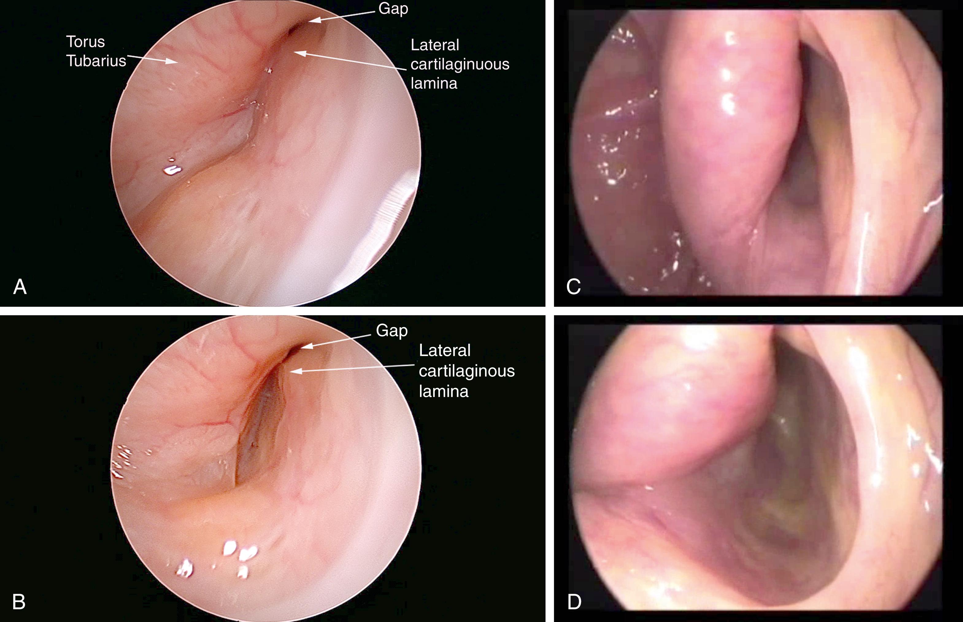 Fig. 6.2, Patulous eustachian tubes (left) in a 45-degree, 3-mm diameter endoscopic view. The patient is seated in the office. (A) Small defect, resting position. There is only a small gap (i.e., defect) located at the 12:00 position within the valve and superior to the convex bulge of the lateral cartilaginous lamina in the anterolateral wall. The mucosa are normal. (B) Small defect, open position. (C) Large defect, resting position. There is a wide concave defect in the anterolateral wall involving the entire cross-sectional height of the valve except for the normal-appearing convex bulge of the lateral cartilaginous lamina located at the 12:00 position. The mucosa are normal. (D) Large defect, open position. The normal convex bulge of the lateral cartilaginous lamina otherwise stands out in contrast to the large concave defect in the entire anterolateral wall.