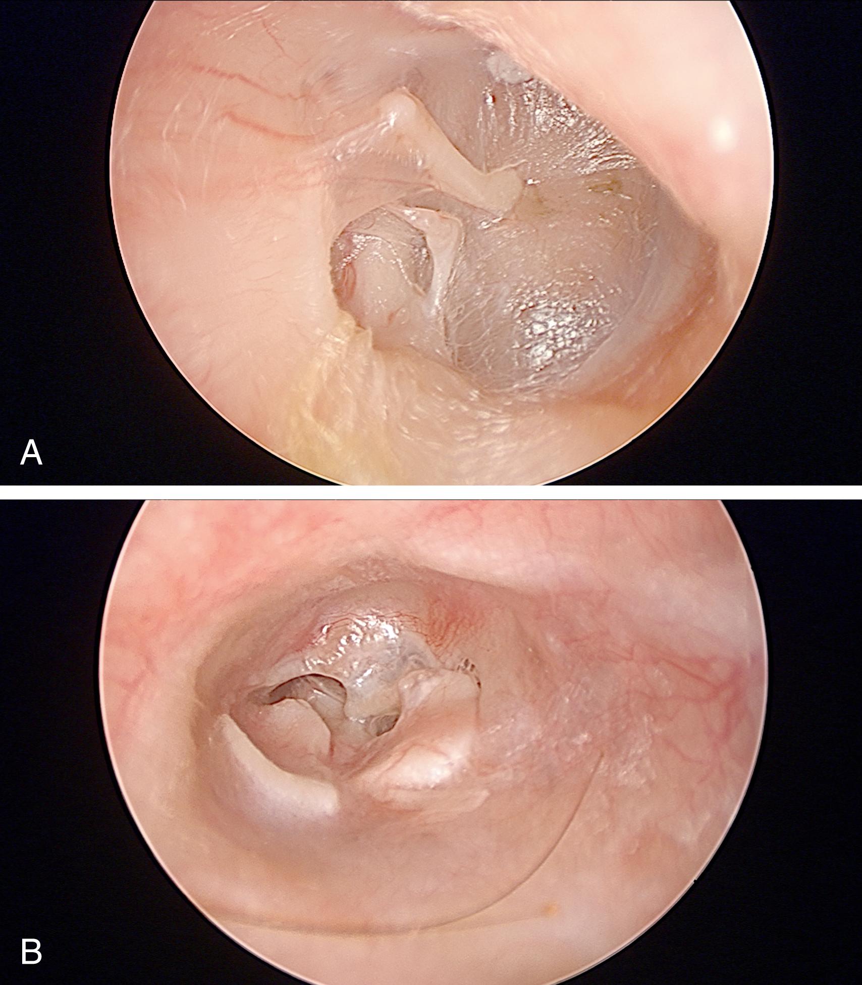 Fig. 6.3, Tympanic membranes with chronic ear disease and patulous eustachian tubes. Endoscopic views, 0-degree, 4-mm. (A) Right tympanic membrane with fixed posterior superior retraction pocket and incus erosion. (B) Left tympanic membrane with cartilage graft reconstruction after tympanomastoid surgery for cholesteatoma. The central inferior retraction pocket displayed excursions with nasal breathing.