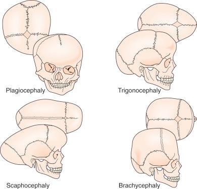 Figure 9.1, Restriction of growth at particular sutures will lead to characteristically abnormal head shapes. Unicoronal synostosis is associated with ipsilateral flattening of the supraorbital and frontal regions with contralateral compensatory frontal bossing (anterior plagiocephaly). Premature closure of the metopic suture may lead to the formation of a triangular-shaped head (trigonocephaly). Sagittal synostosis is marked by an elongated and narrowed head (scaphocephaly). Bilateral coronal synostosis leads to a short, wide head with frontal towering (brachycephaly).