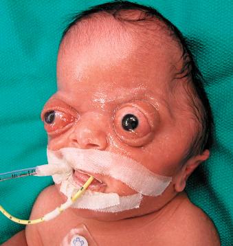Figure 9.2, Newborn infant with Pfeiffer syndrome presenting with a cloverleaf skull (Kleeblattschädel) deformity. This is characterized by frontal towering, bitemporal expansion, bilateral supraorbital recession and proptosis, and midfacial hypoplasia.