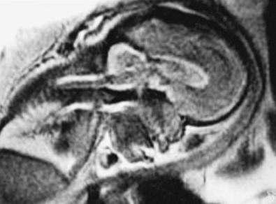 Figure 9.4, Sagittal MRI of a 30-week fetus with Pfeiffer syndrome depicting a cloverleaf skull, which required a near-total calvarectomy within the first week of life.